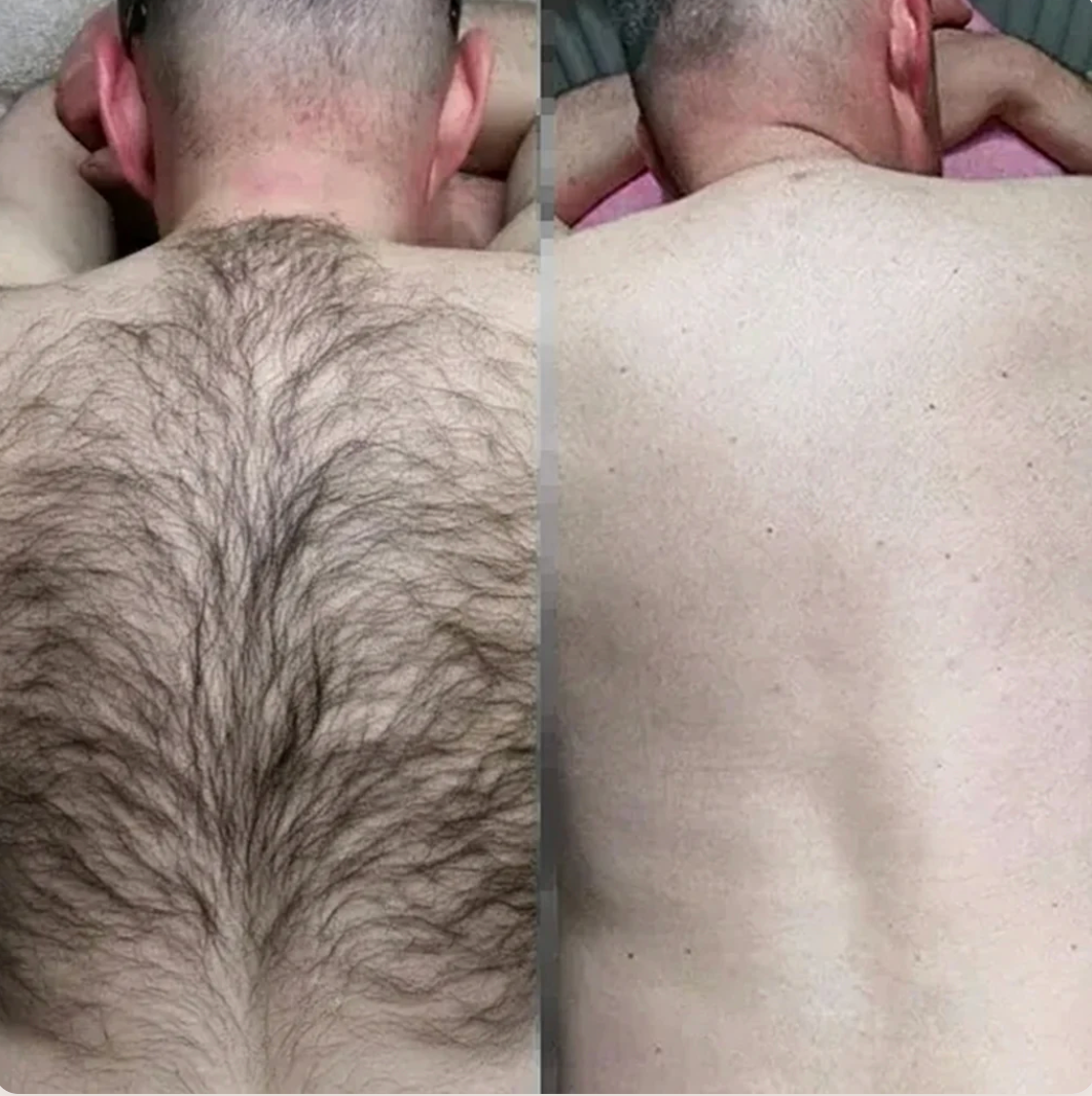 Customer review before and after back hair removal