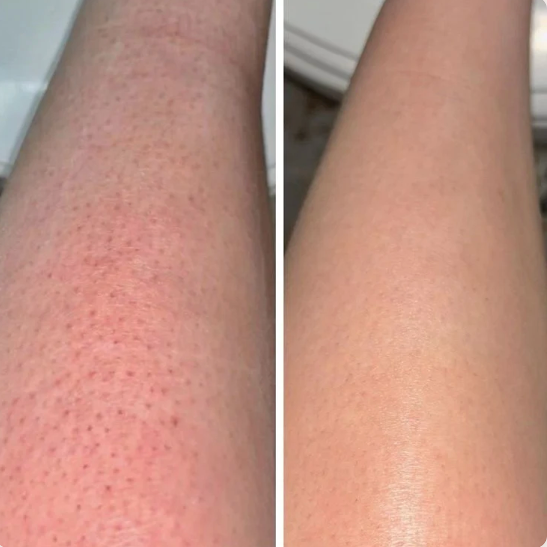 Customer review before and after leg hair removal