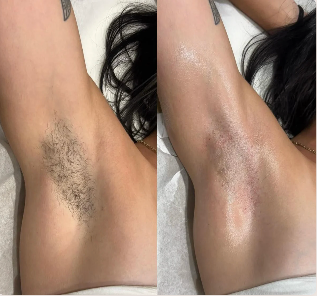 Customer review before and after underarm hair removal