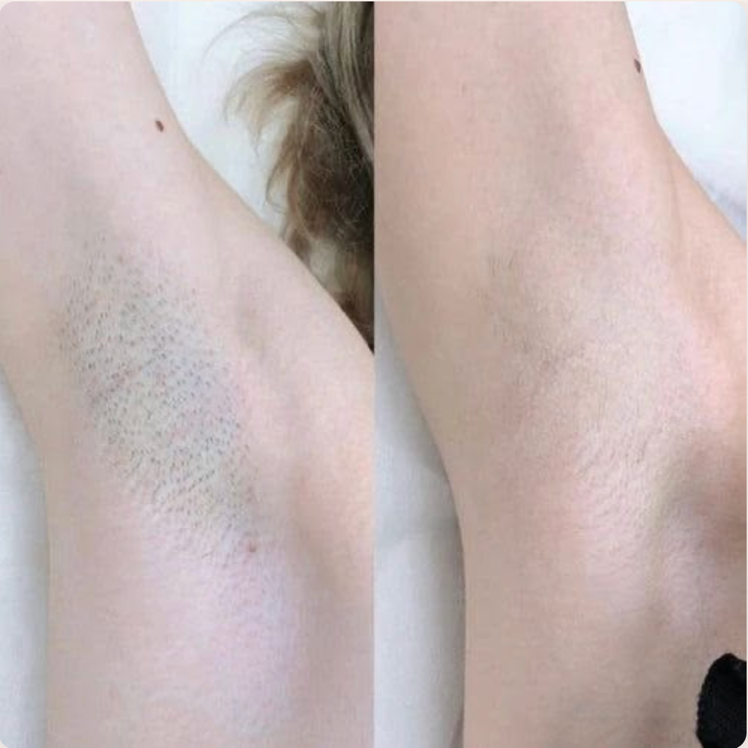 Customer before and after hair removal review
