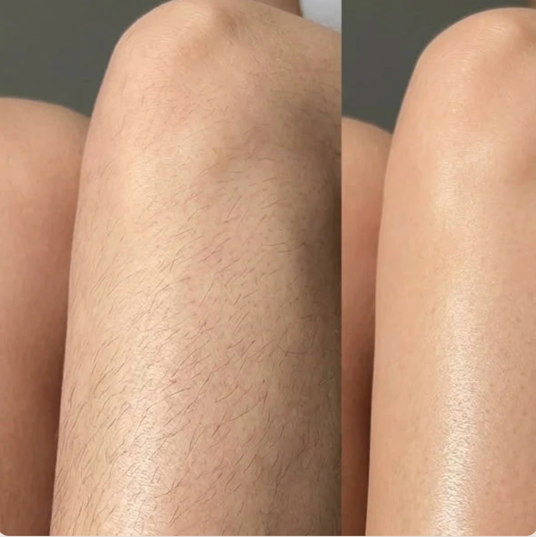 Customer before and after leg hair removal review