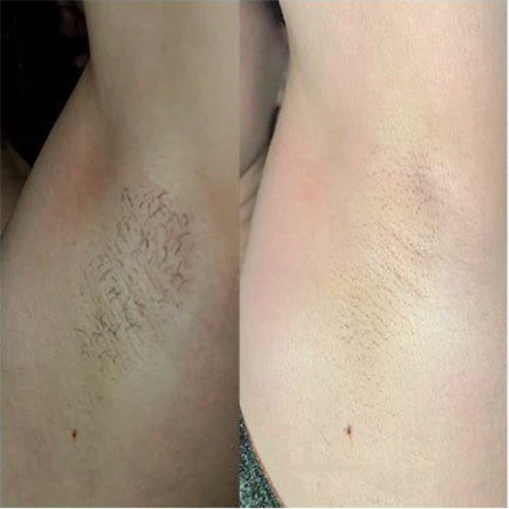 Customer before and after underarm hair removal review